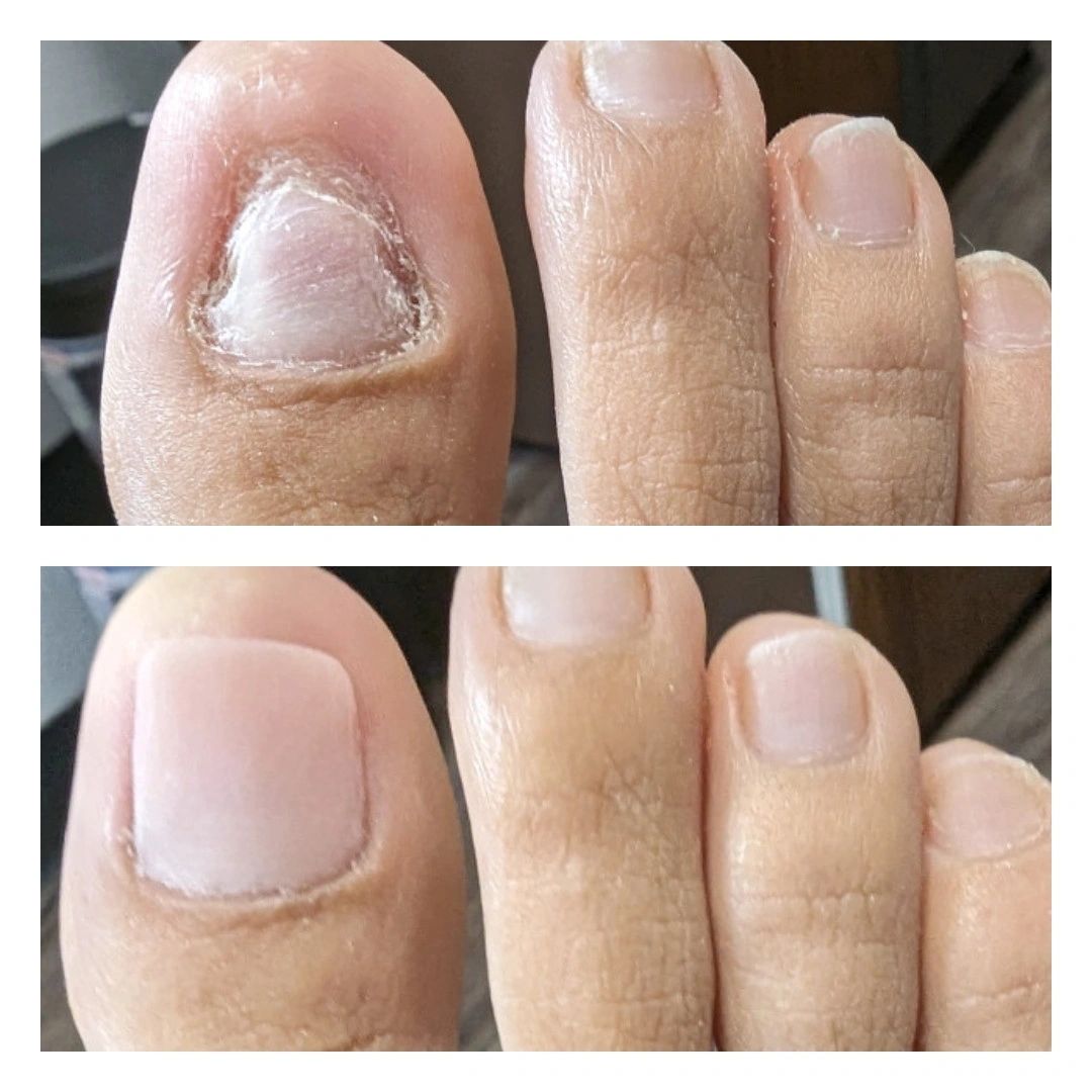 Amy’s actual cosmetic toenail reconstruction work: original toenail above, reconstructed toenail below